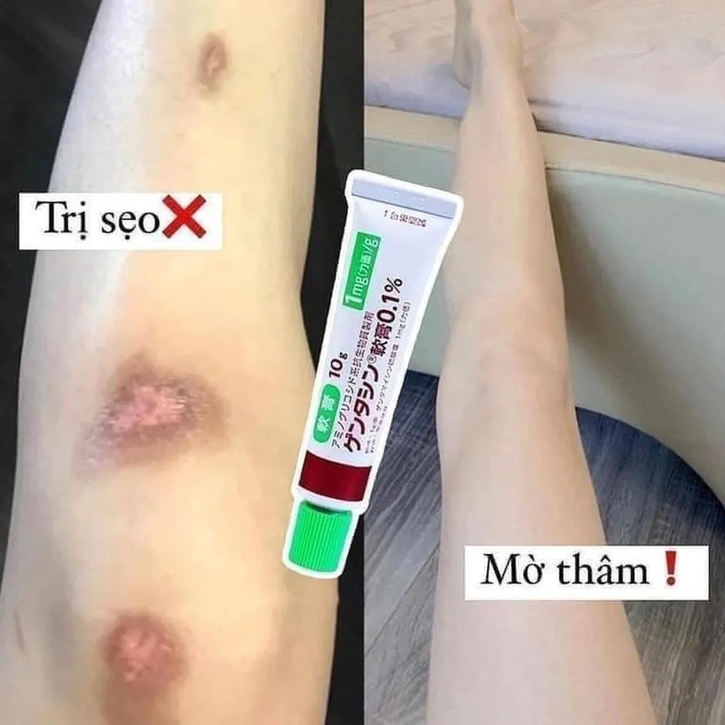 Alternative view of Kem Trị Sẹo Nhật Bản 0.1% - Gentacin