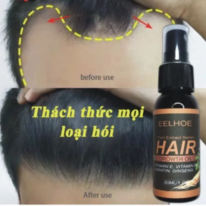 Alternative view of Xịt Mọc Tóc Nhân Sâm Giảm Rụng, Kích Mọc, Cải Thiện Hói Nấm Da Đầu 30ml - Gdn