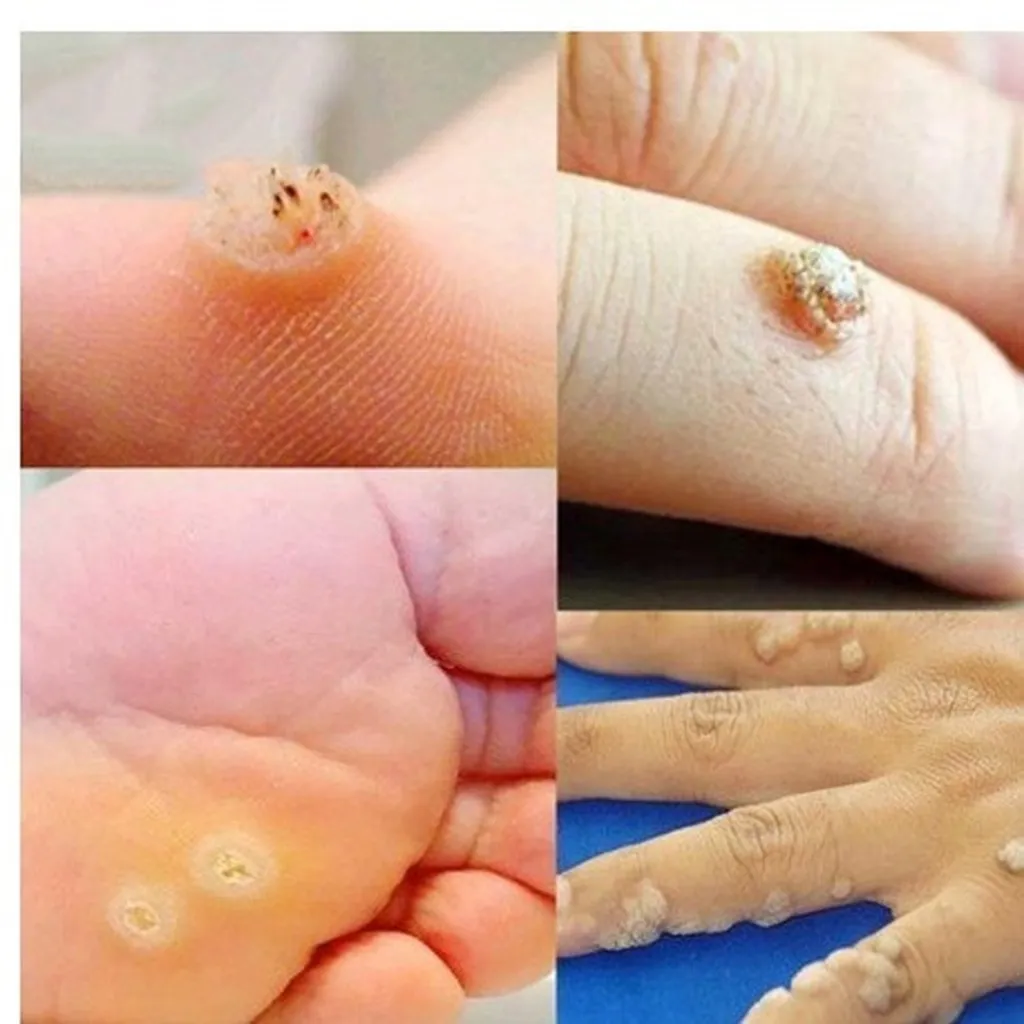 Alternative view of Serum Mụn Cóc, Mắt Cá, Chai Chân - Gdn
