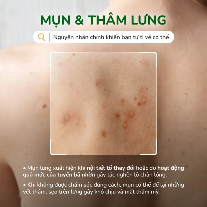 Alternative view of Combo 2 Chai Xịt Giảm Mụn Lưng Neoacnes